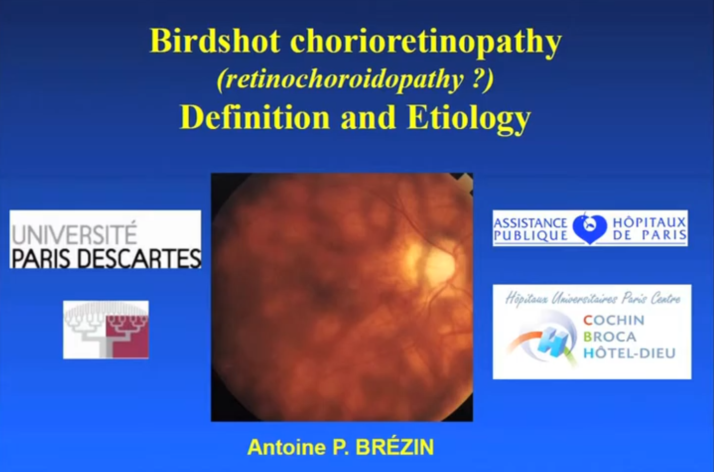 Vignette video Birdshot Brezin Ophtara Cochin